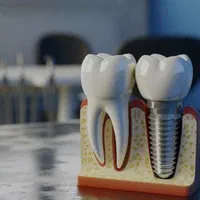 خدمات ایمپلنت دیجیتال|خدمات آرایشگری و زیبایی|شیراز, معالی‌آباد|دیوار