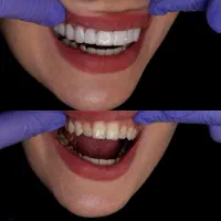 انجام لمینت متحرک دندان|خدمات آرایشگری و زیبایی|تهران, تهرانپارس غربی|دیوار