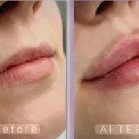 ژل وفیلر وتاکس.فیلربادی.مزووکرمپودربامشاوره رایکان