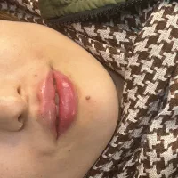 تخفیف تکرار نشدنی فیلر و بوتاکس کلینیک رازیل