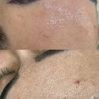 فیشال و پاکسازی تخصصی پوست