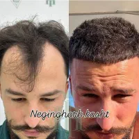 کاشت مو سوپرFIT فقط 16.900