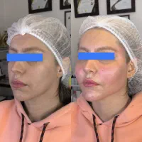 تزریق چربی، فیلر،بوتاکس/ساکشن چربی وتخلیه غبغب