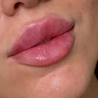 فیلربوتاکس‌بابهترین برندها فقط سی سی ۹۰۰فرصت‌ویژه