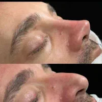 جراحی بینی بدون تامپون+اقساط بلند مدت/تهران