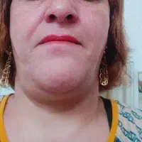 لیفت فوری صورت بدون تزریق و تضمینی