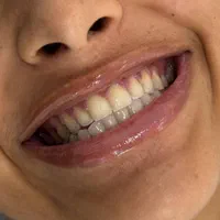 ایمپلنت ،کامپوزیت ،لمینت ،روکش ،عصب کشی وپر|پزشکی|تهران, سلسبیل جنوبی|دیوار