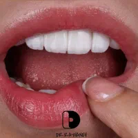 کامپوزیت/لمینت/دندانپزشکی