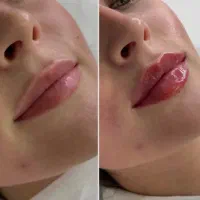 لیزر مو ، فشیال ، پی آر پی، ژل و بوتاکس