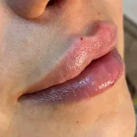 جراحی بینی لیفت بوتاکس نخ مزو فیلر فشیال|خدمات آرایشگری و زیبایی|شاهین‌شهر, عطار|دیوار