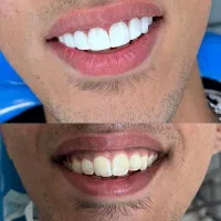 خدمات کامپوزیت دندان با اقساط آسان|خدمات آرایشگری و زیبایی|قم, صفائیه|دیوار