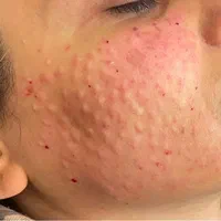 جشنواره تخفیفات ویژه مزوتراپی پوست و مو درکلینیک|خدمات آرایشگری و زیبایی|اصفهان, درب کوشک|دیوار