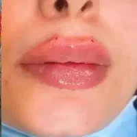 لیزر موفیشال لاغری پوست فیلر بوتاکس ویژه بانوان|خدمات آرایشگری و زیبایی|خمینی‌شهر, |دیوار