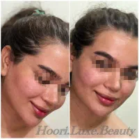 تزریق ژل و بوتاکس