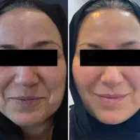 درمان تضمینی لک با کرم اروپایی بدون بازگشت