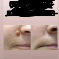پاک کردن تاتو برداشتن خال