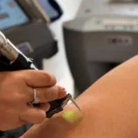 لیزر تضمینی دِکا دربروجرد