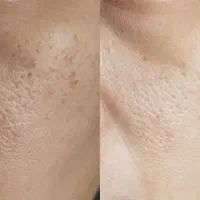 آموزش prp بایوفیلر لیفت نخ،پلاسماژل  مدل سابسیژن