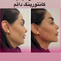 ساکشن غبغب بلفارو کاشت ابرو بوکال فت|خدمات آرایشگری و زیبایی|تهران, میرداماد|دیوار