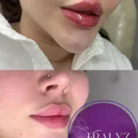 ژل بوتاکس مزو و مزو تراپی