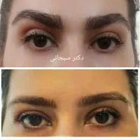 جراحی پلک بلفاروپلاستی لیفت ابرو شقیقه صورت پیشانی|خدمات آرایشگری و زیبایی|تهران, سلسبیل شمالی|دیوار