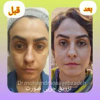 جشنواره ساکشن تخصصی غبغب و تزریق چربی اقساط|خدمات آرایشگری و زیبایی|تهران, شهر زیبا|دیوار