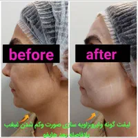 جشنواره  تابستانه ی هایفو ۷ بعدی فقط به مدت ۱۰ روز|خدمات آرایشگری و زیبایی|تهران, آسمان|دیوار