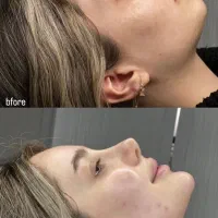 جشنواره تخفیف ژل لب و بوتاکس|خدمات آرایشگری و زیبایی|کرج, خرمدشت|دیوار