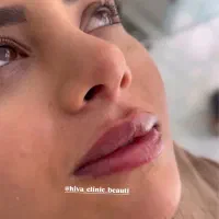 آموزش،پی ار پی مزوبوتاکس بایوفیلر غبغب چربی ساکشن|خدمات آرایشگری و زیبایی|اصفهان, شاهزید|دیوار