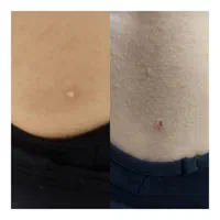 فیشیال تخصصی صورت وخالبرداری تخصصی وپلاسماتراپی|خدمات آرایشگری و زیبایی|قم, شهرک فاطمیه|دیوار