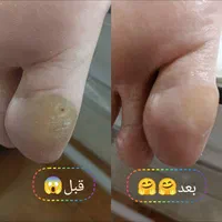 پدیکوریست خاص/ترک/پینه/قوزک|خدمات آرایشگری و زیبایی|قم, سالاریه|دیوار