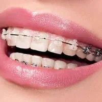کامپوزیت ،لمینیت ،ایمپلنت ،ارتودنسی