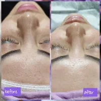 پاکسازی و فیشال صورت