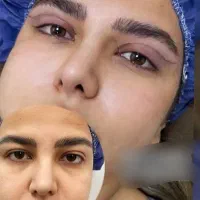 جراحی بلفاروپلاستی/افتاددگی پلک/مشاوره رایگان