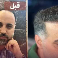 کاشت مو قیمت ۱۸میلیون با شرایط اقساطی