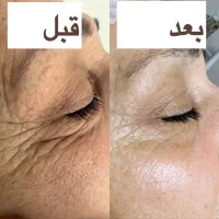 جوانسازی فوری/در یک جلسه/در یک ساعت|خدمات آرایشگری و زیبایی|رشت, کوی حسینی|دیوار