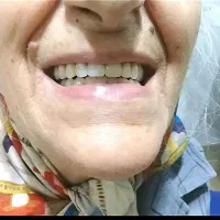 پروتز دندان|خدمات آرایشگری و زیبایی|ابهر, |دیوار