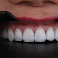دندانپزشکی ملاصدرا کف کف قیمت
