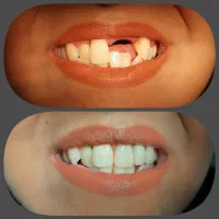 پروتز ثابت جایگزین ایمپلنت تحویل یکروزه