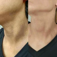 رفع تیرگی صورت وبدن فیشال تخصصی