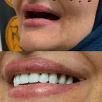 دندانسازی ساخت دندان مصنوعی|خدمات آرایشگری و زیبایی|خرمآباد, |دیوار