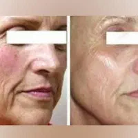 جراحی بینی ابدو،چربی لیپو 360ترانسفر باسن بیکینی|خدمات آرایشگری و زیبایی|اندیشه, اندیشه فاز ۱|دیوار