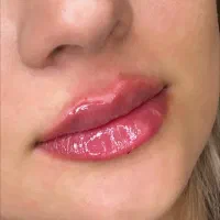 ژل لب وکانتورینگ صورت با پزشک از۱/۶۰۰تومان باتخفیف