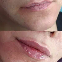 فیلر بوتاکس توسط پزشک