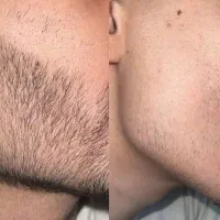 بمب رشد و پرپشتی مو و ریش و سبیل توی 22 روز تضمینی