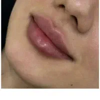 تزریق ژل بوتاکس|خدمات آرایشگری و زیبایی|شیراز, نصرآباد|دیوار