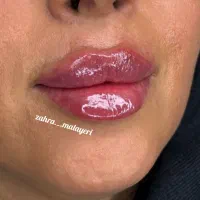 تزریق ژل فیلر تضمینی بوتاکس پرسینگ چاله گونه|خدمات آرایشگری و زیبایی|قم, نیروگاه|دیوار