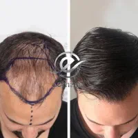 کاشت مو و ریش اقساط