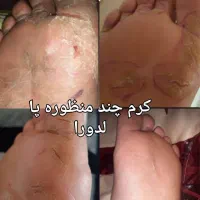 کرم ترک پای قوی لدورا ترمیم سریع ترک و خشکی|آرایشی، بهداشتی، درمانی|شاهرود, |دیوار