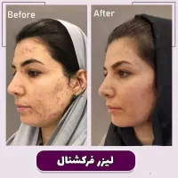 جوانسازی پوست و نواحی بانوان با لیزر تخصصی فوتونا|خدمات آرایشگری و زیبایی|محمدیه-قزوین, |دیوار